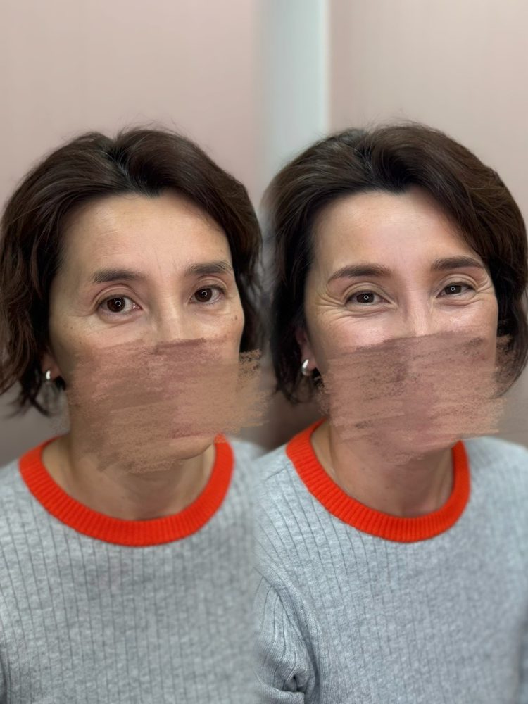Before/After
